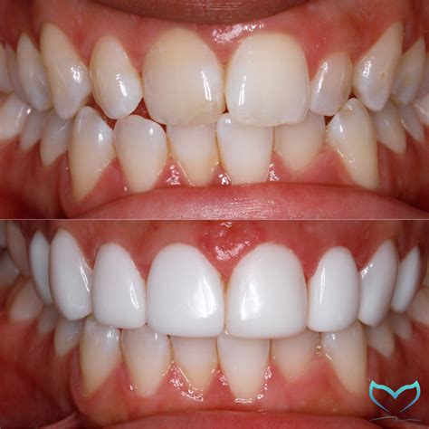composite veneers near me